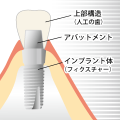 インプラントの構造